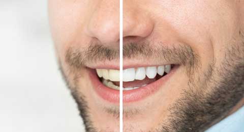 Före och efter bild på blekta tänder
